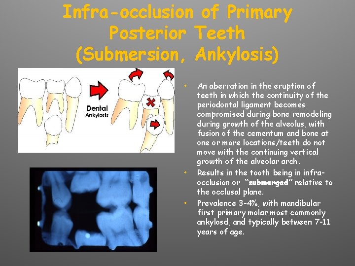 Infra-occlusion of Primary Posterior Teeth (Submersion, Ankylosis) • • • An aberration in the