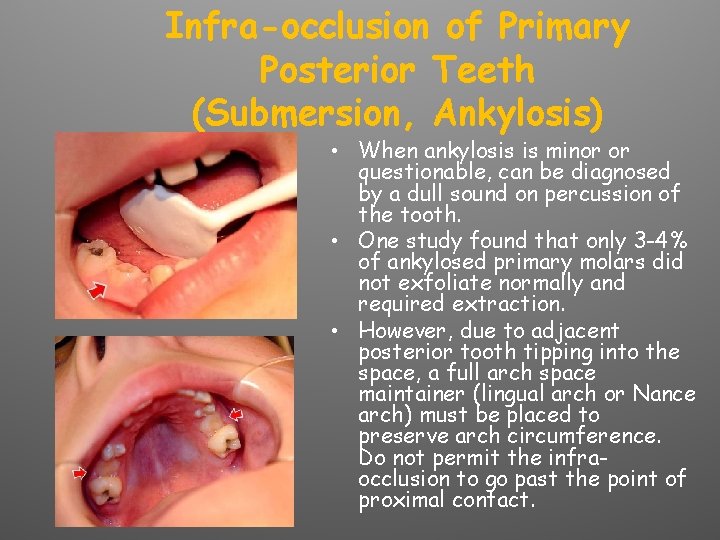 Infra-occlusion of Primary Posterior Teeth (Submersion, Ankylosis) • When ankylosis is minor or questionable,