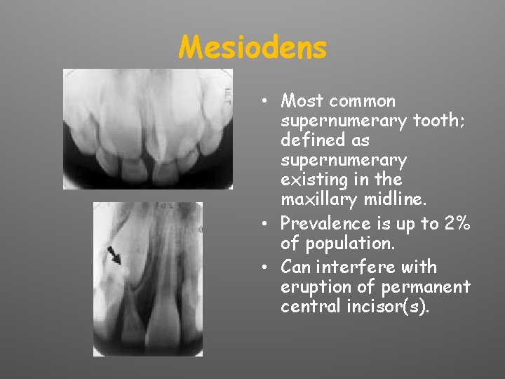 Mesiodens • Most common supernumerary tooth; defined as supernumerary existing in the maxillary midline.