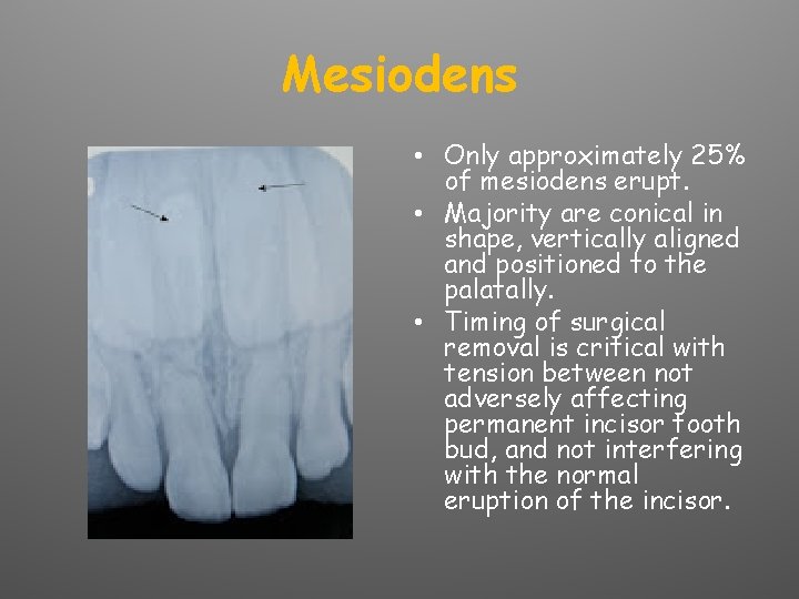 Mesiodens • Only approximately 25% of mesiodens erupt. • Majority are conical in shape,