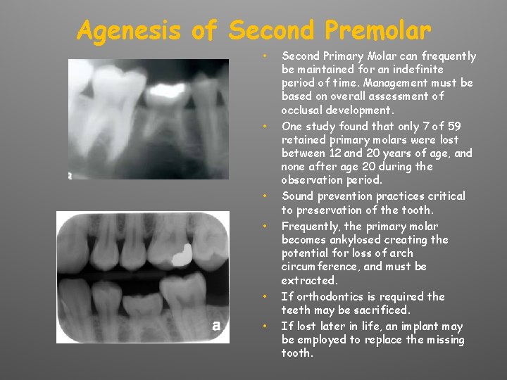 Agenesis of Second Premolar • • • Second Primary Molar can frequently be maintained
