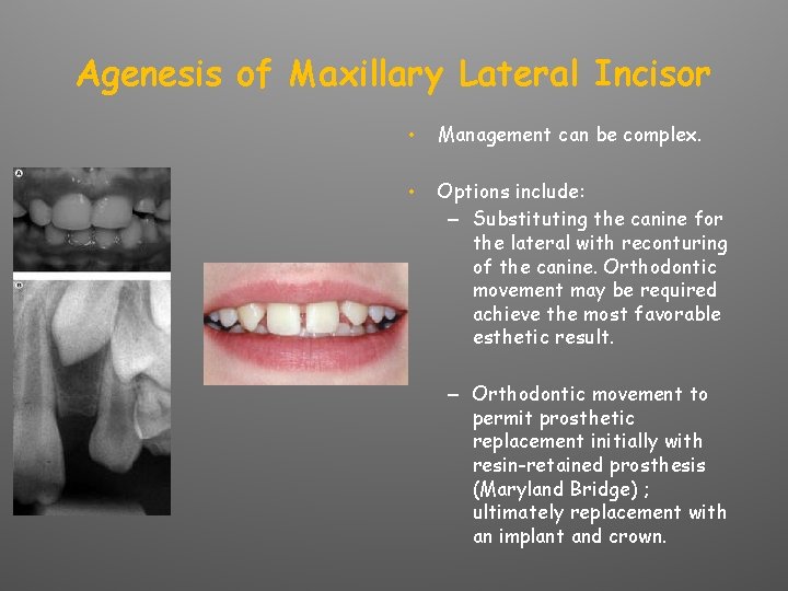 Agenesis of Maxillary Lateral Incisor • Management can be complex. • Options include: –
