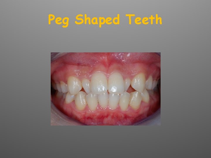 Peg Shaped Teeth 