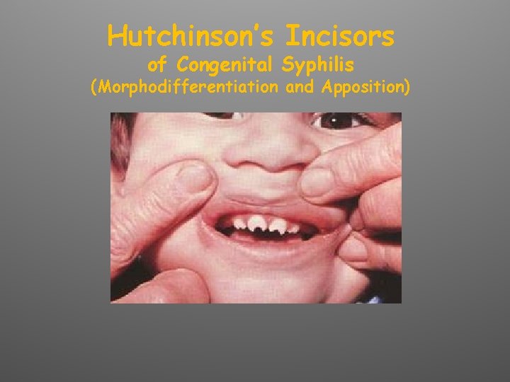 Hutchinson’s Incisors of Congenital Syphilis (Morphodifferentiation and Apposition) 