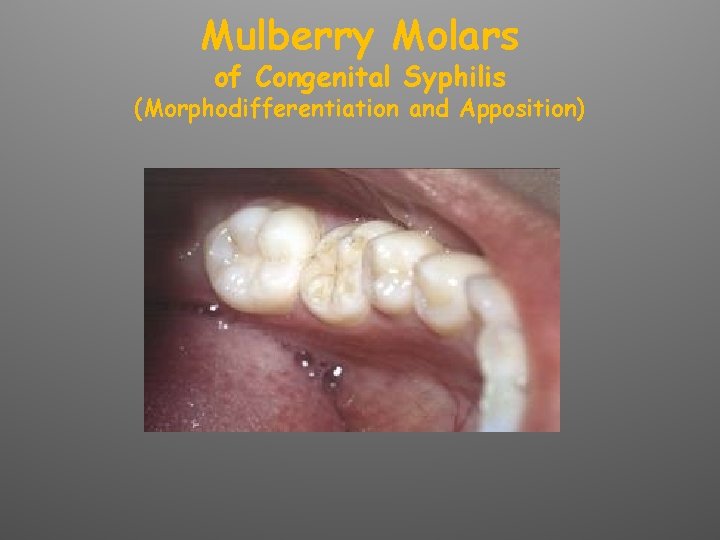 Mulberry Molars of Congenital Syphilis (Morphodifferentiation and Apposition) 