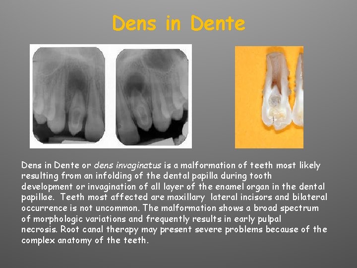 Dens in Dente or dens invaginatus is a malformation of teeth most likely resulting