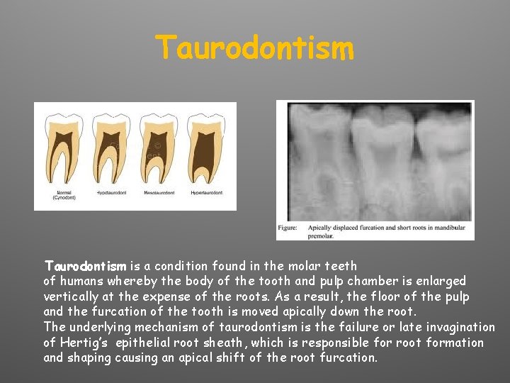 Taurodontism is a condition found in the molar teeth of humans whereby the body