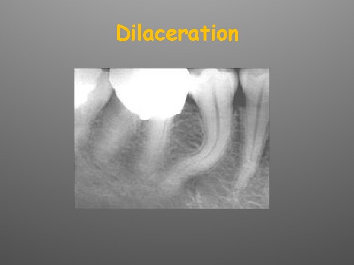 Dilaceration 