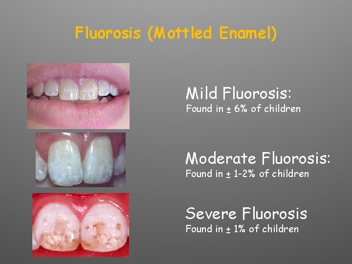 Fluorosis (Mottled Enamel) Mild Fluorosis: Found in ± 6% of children Moderate Fluorosis: Found