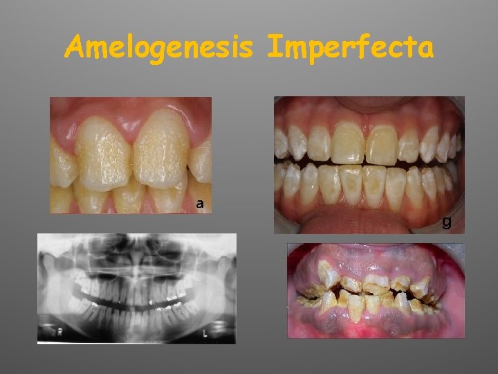 Amelogenesis Imperfecta 