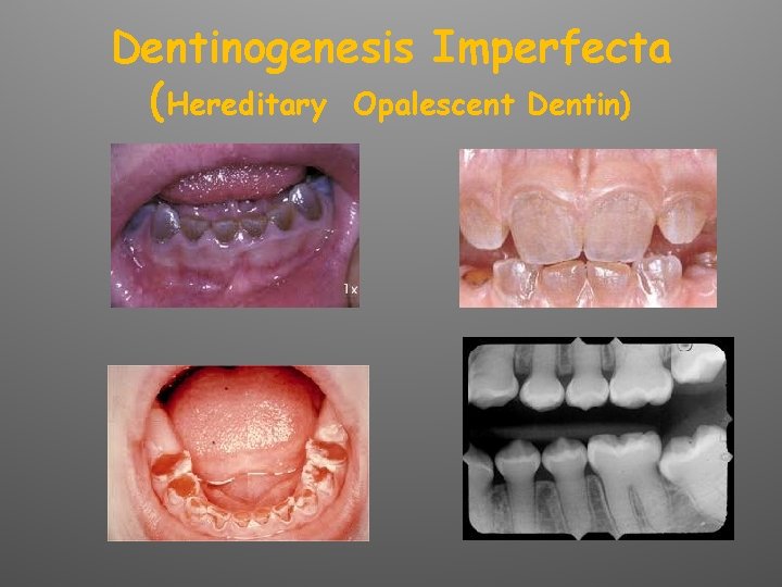 Dentinogenesis Imperfecta (Hereditary Opalescent Dentin) 