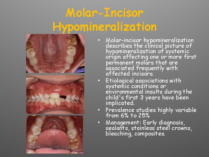 Molar-Incisor Hypomineralization • Molar-incisor hypomineralization describes the clinical picture of hypomineralization of systemic origin