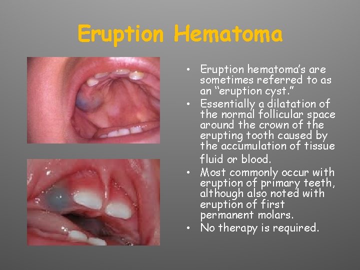 Eruption Hematoma • Eruption hematoma’s are sometimes referred to as an “eruption cyst. ”