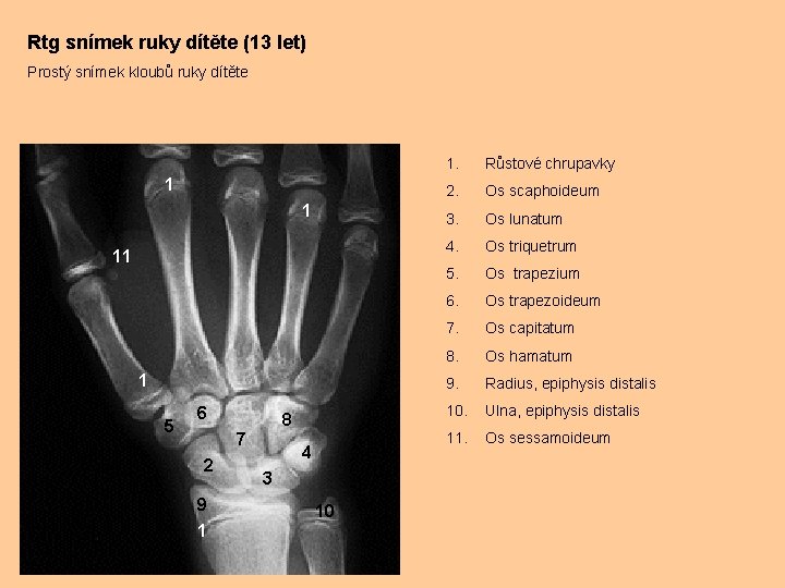 Rtg snímek ruky dítěte (13 let) Prostý snímek kloubů ruky dítěte 1 1 11