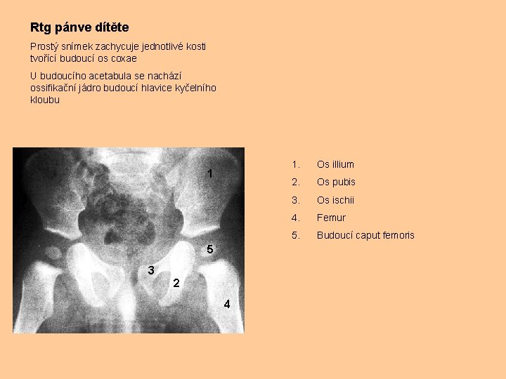 Rtg pánve dítěte Prostý snímek zachycuje jednotlivé kosti tvořící budoucí os coxae U budoucího