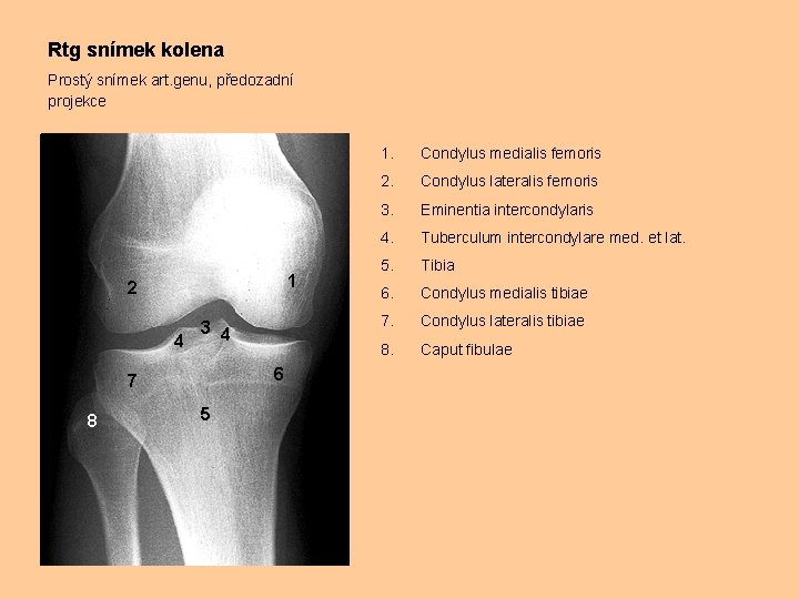 Rtg snímek kolena Prostý snímek art. genu, předozadní projekce 1 2 3 4 4