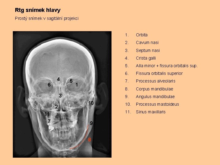 Rtg snímek hlavy Prostý snímek v sagitální projekci 4 6 5 1 3 2