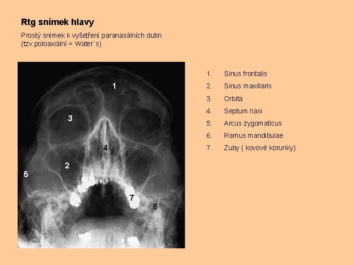 Rtg snímek hlavy Prostý snímek k vyšetření paranasálních dutin (tzv. poloaxiální = Water´s) 1