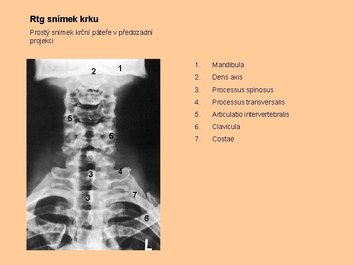 Rtg snímek krku Prostý snímek krční páteře v předozadní projekci 1 2 5 5