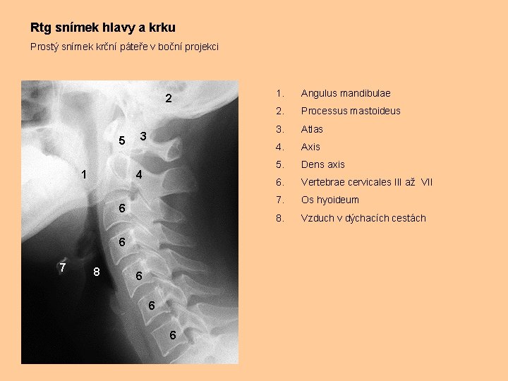 Rtg snímek hlavy a krku Prostý snímek krční páteře v boční projekci 2 5