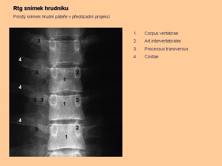 Rtg snímek hrudníku Prostý snímek hrudní páteře v předozadní projekci 3 4 3 2