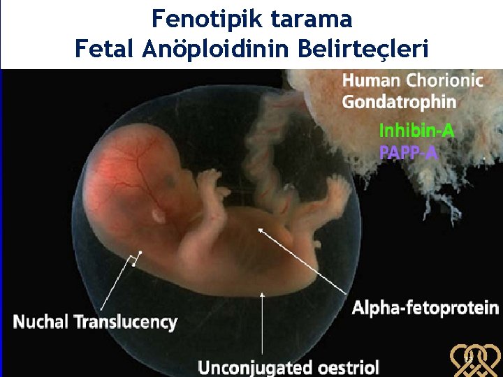 Fenotipik tarama Fetal Anöploidinin Belirteçleri 12 12 