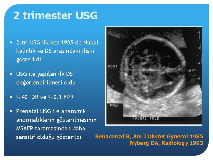 2 trimester USG § 2. tri USG ilk kez 1985 de Nukal kalınlık ve