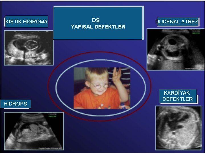 KİSTİK HİGROMA HİDROPS DS YAPISAL DEFEKTLER DUDENAL ATREZİ KARDİYAK DEFEKTLER 