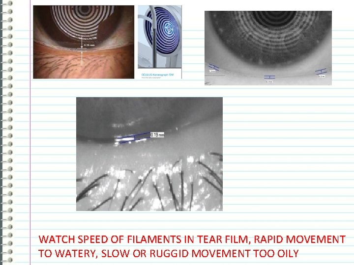 WATCH SPEED OF FILAMENTS IN TEAR FILM, RAPID MOVEMENT TO WATERY, SLOW OR RUGGID