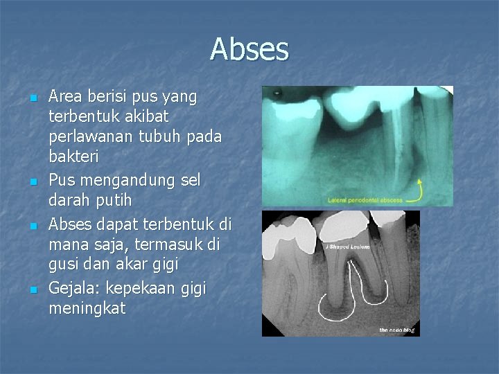 Abses n n Area berisi pus yang terbentuk akibat perlawanan tubuh pada bakteri Pus