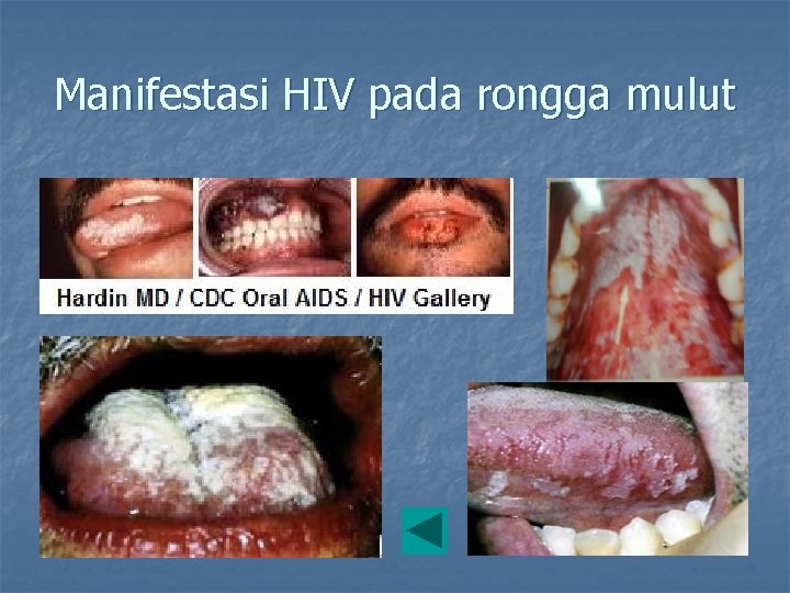 Manifestasi HIV pada rongga mulut 