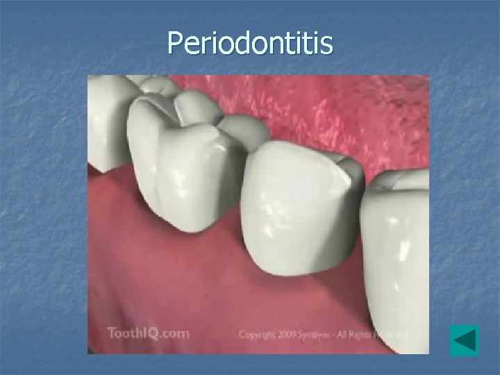 Periodontitis 