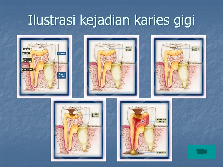 Ilustrasi kejadian karies gigi 