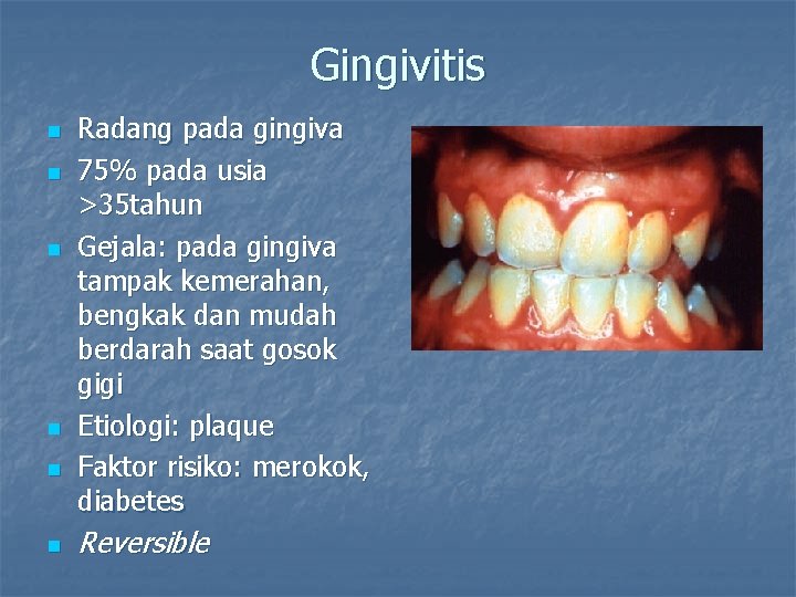 Gingivitis n n n Radang pada gingiva 75% pada usia >35 tahun Gejala: pada