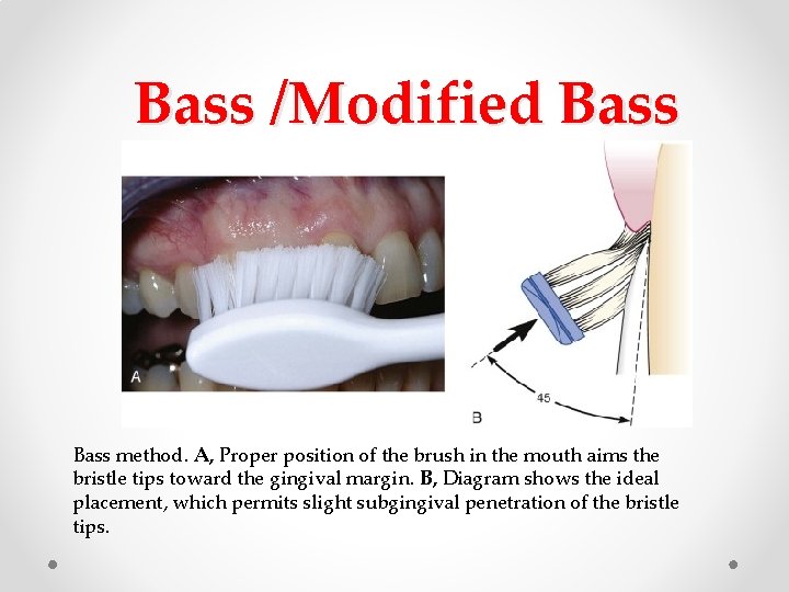 Bass /Modified Bass method. A, Proper position of the brush in the mouth aims Bass /Modified Bass method. A, Proper position of the brush in the mouth aims
