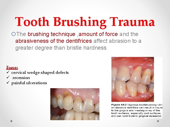 Tooth Brushing Trauma The brushing technique , amount of force and the abrasiveness of Tooth Brushing Trauma The brushing technique , amount of force and the abrasiveness of