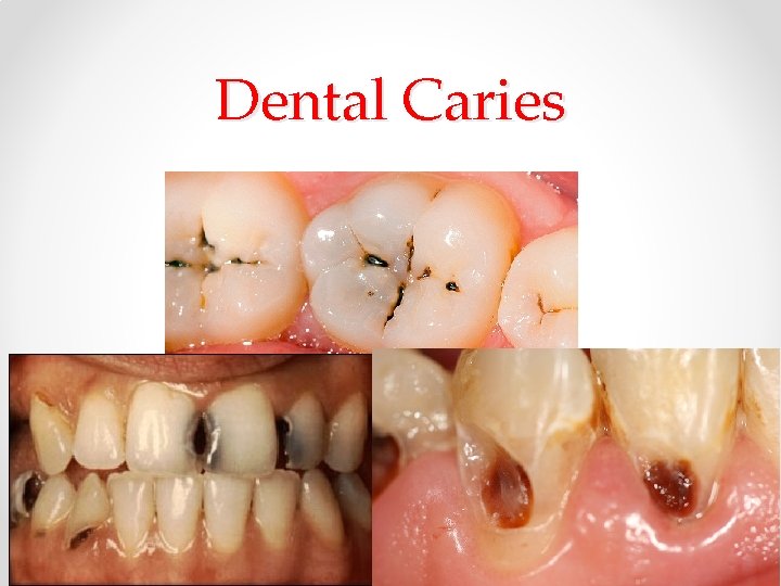 Dental Caries Dental Caries