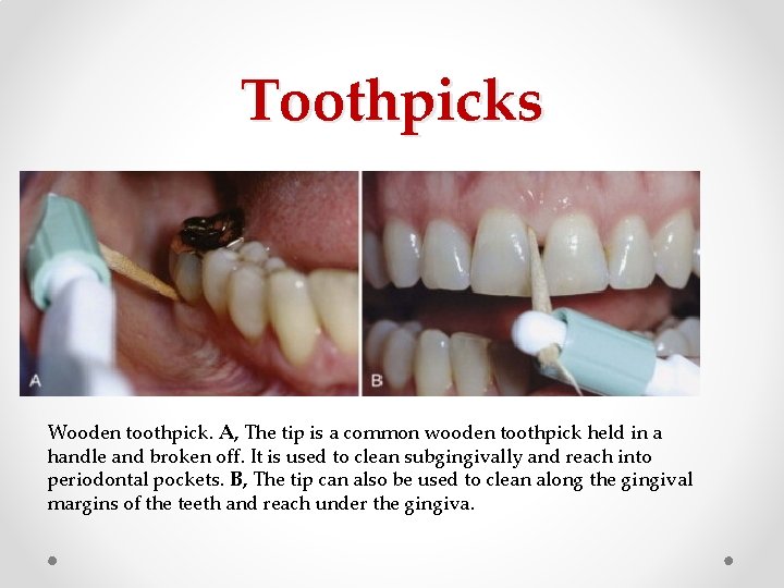 Toothpicks Wooden toothpick. A, The tip is a common wooden toothpick held in a Toothpicks Wooden toothpick. A, The tip is a common wooden toothpick held in a