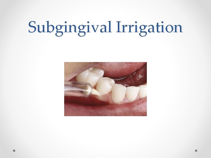 Subgingival Irrigation Subgingival Irrigation