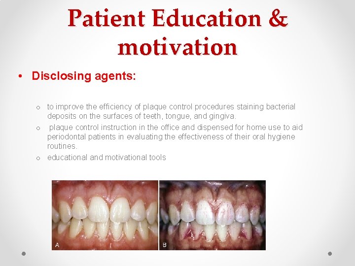 Patient Education & motivation • Disclosing agents: o to improve the efficiency of plaque Patient Education & motivation • Disclosing agents: o to improve the efficiency of plaque