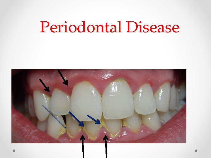 Periodontal Disease Periodontal Disease