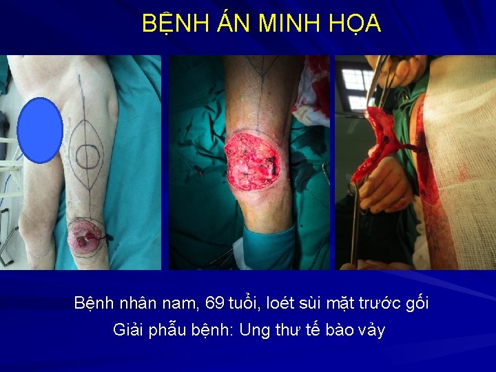 BỆNH ÁN MINH HỌA Bệnh nhân nam, 69 tuổi, loét sùi mặt trước gối