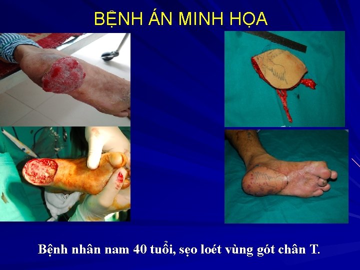 BỆNH ÁN MINH HỌA Bệnh nhân nam 40 tuổi, sẹo loét vùng gót chân