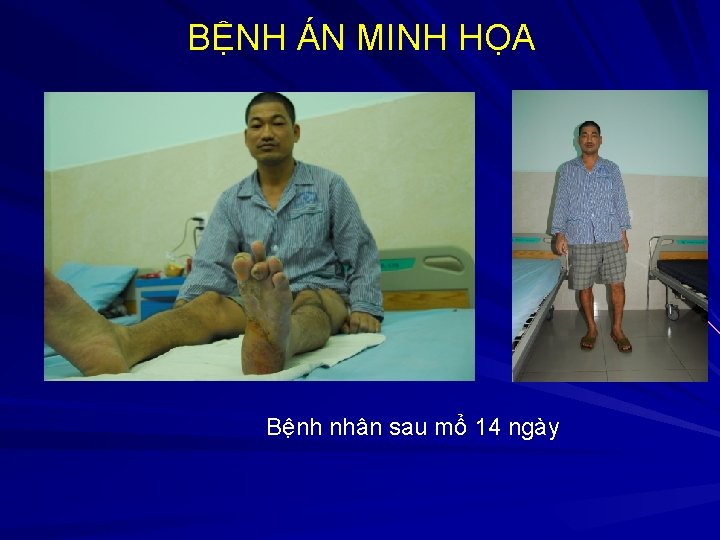 BỆNH ÁN MINH HỌA Bệnh nhân sau mổ 14 ngày 