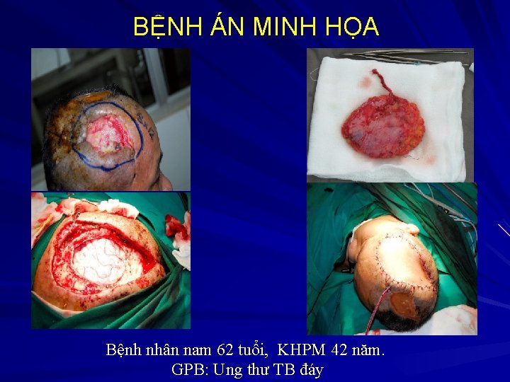 BỆNH ÁN MINH HỌA Bệnh nhân nam 62 tuổi, KHPM 42 năm. GPB: Ung