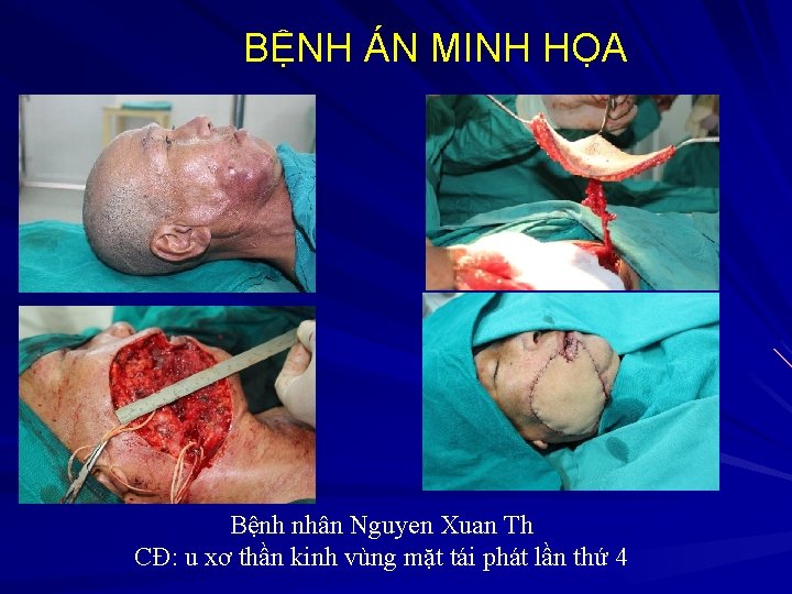 BỆNH ÁN MINH HỌA Bệnh nhân Nguyen Xuan Th CĐ: u xơ thần kinh