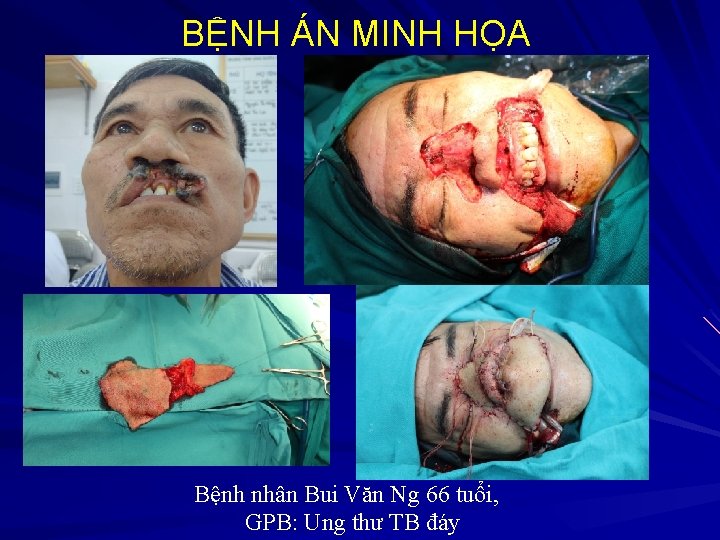 BỆNH ÁN MINH HỌA Bệnh nhân Bui Văn Ng 66 tuổi, GPB: Ung thư