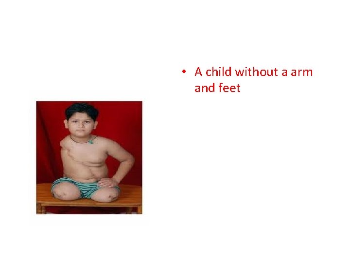  • A child without a arm and feet 