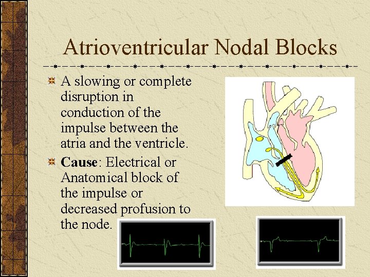 Atrioventricular Nodal Blocks A slowing or complete disruption in conduction of the impulse between Atrioventricular Nodal Blocks A slowing or complete disruption in conduction of the impulse between