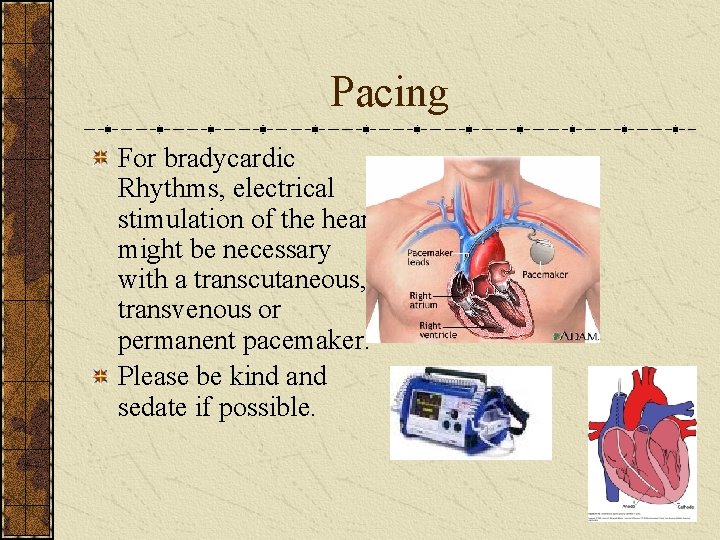 Pacing For bradycardic Rhythms, electrical stimulation of the heart might be necessary with a